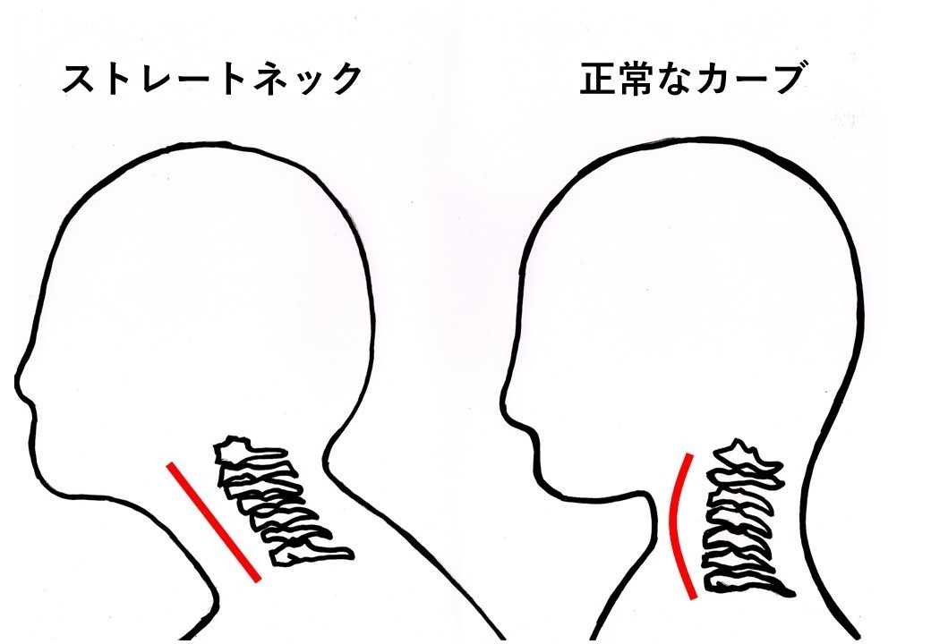 ストレートネック　首のカーブ