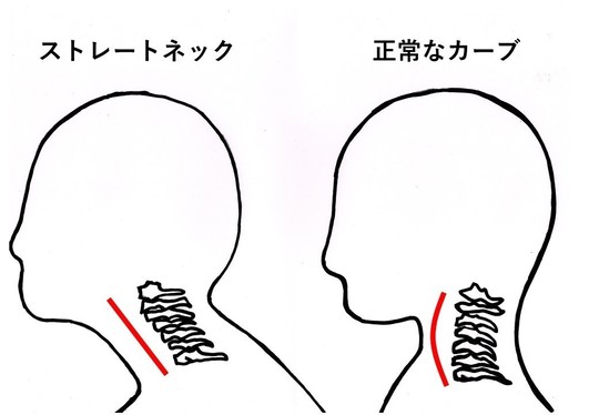 ストレートネック　首のカーブ